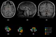 Volumetric analysis of the hypothalamic subunits in obstructive sleep apnea